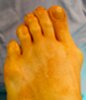 New Rochelle Corrective Bunion Surgery