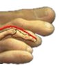 New Rochelle Corrective hammertoe Surgery