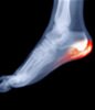 New Rochelle Heel Pain Center